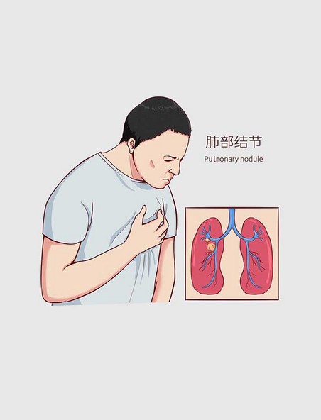 常见医疗人物疾病图例肺部结节
