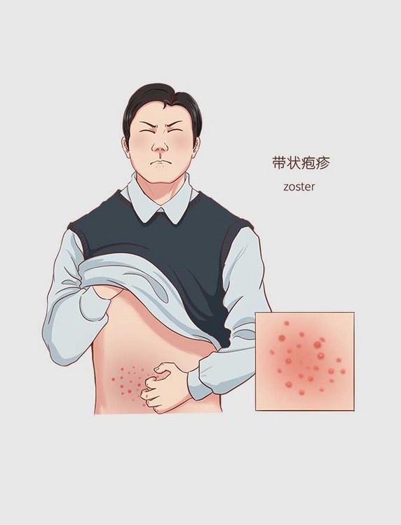 常见医疗人物疾病图例带状疱疹