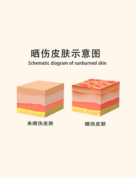 皮肤问题晒伤皮肤示意图图解医疗美容护肤